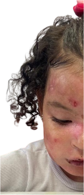 Epidermólise Bolhosa