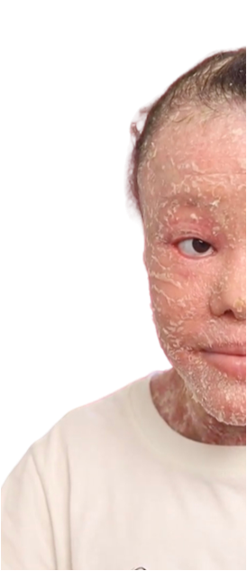 Ictiose