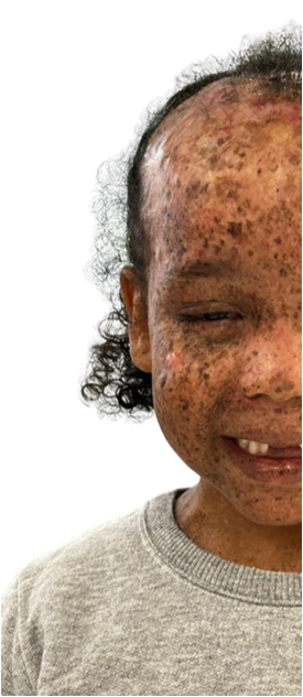 Xeroderma Pigmentoso